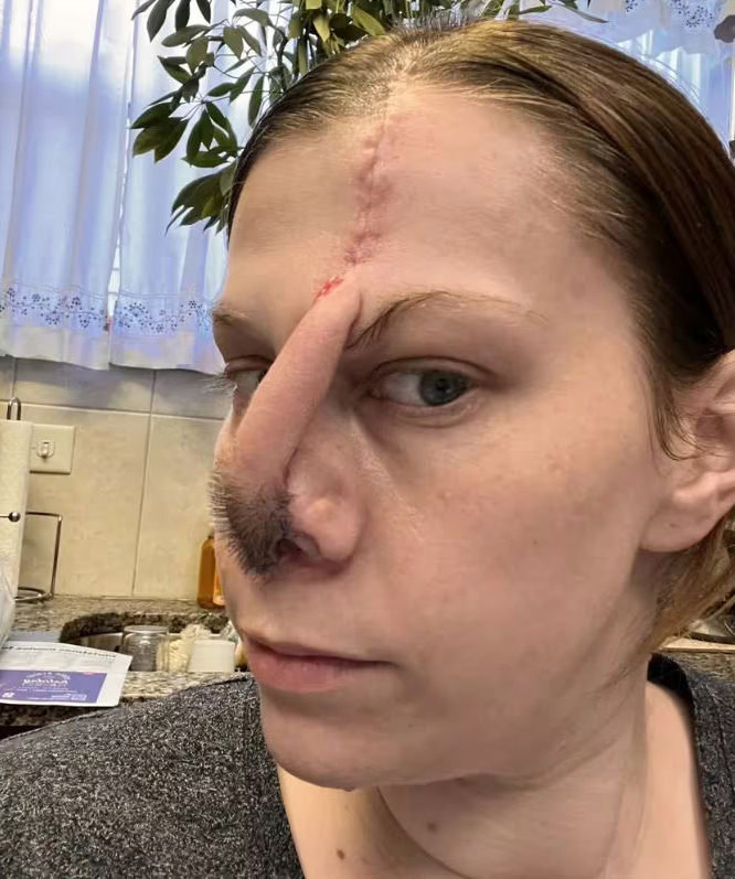 Read more about the article महिला को लग गई ऐसी लत, सुड़कते-सुड़कते गल गई नाक